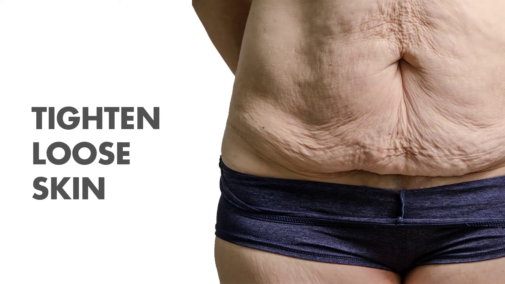 Skin tightening treatment