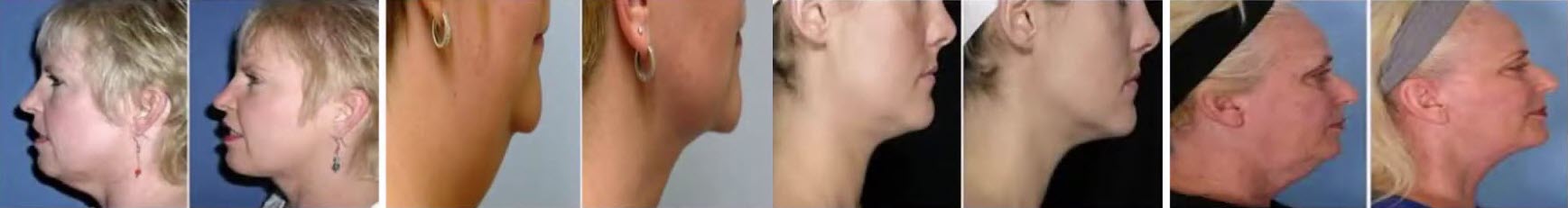 Before and after body sculpting results with invisa-RED™