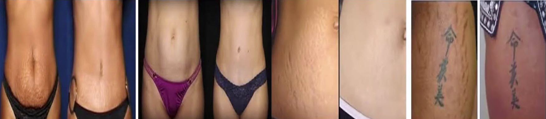 Before and after skin tightening results with invisa-RED™